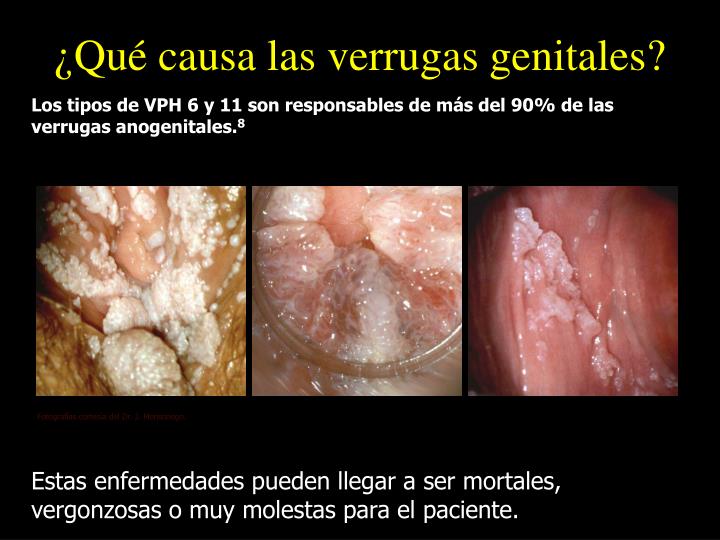 Infecciones Genitales Por El Virus Del Papiloma Humano kulturaupice