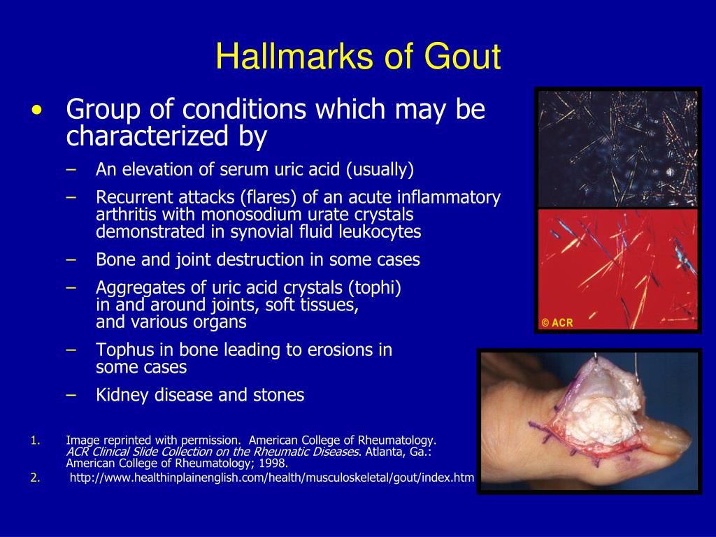 case presentation of gout