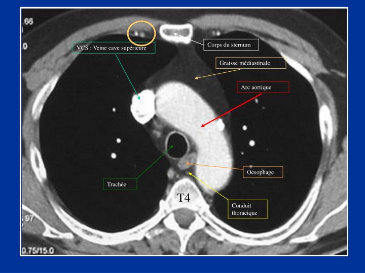 PPT - Scanner thoracique Anatomie du thorax en coupes PowerPoint