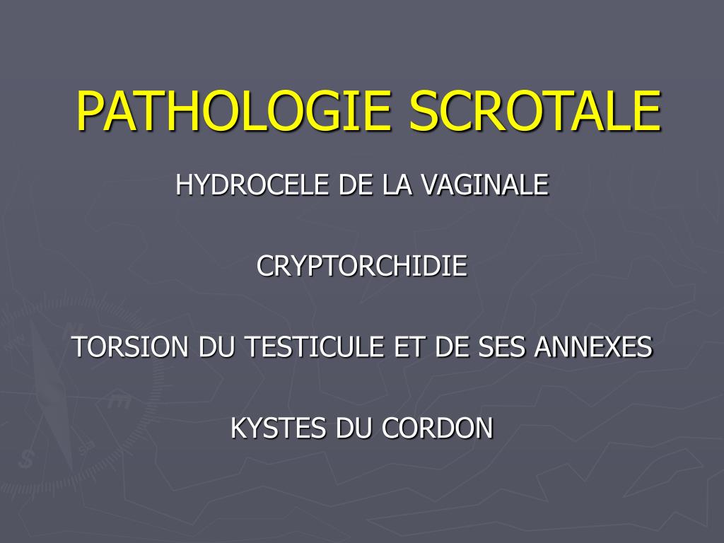 Pathologie des testicules et des bourses : varicocèle, tumeurs