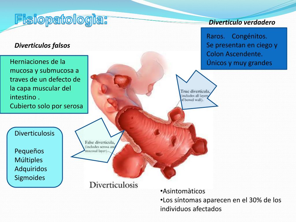 Sintomas diverticulos en el colon