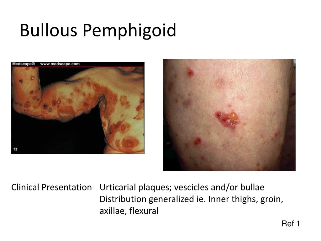 Ppt Bullous Pemphigoid Is Prednisone The Only Option Powerpoint