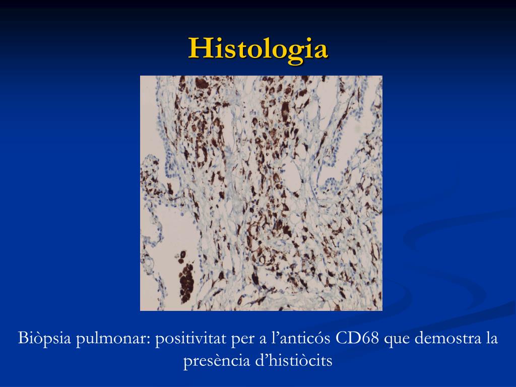 Hipertensión pulmonar erdheim chester