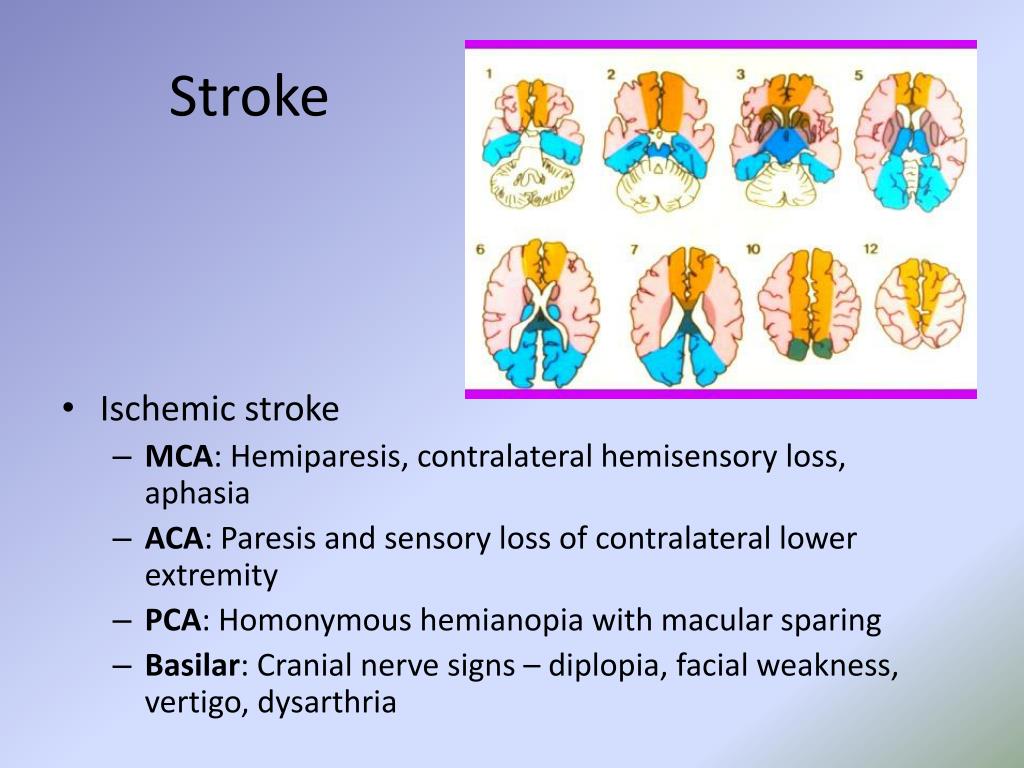 ischemic stroke อาการ diagnosis