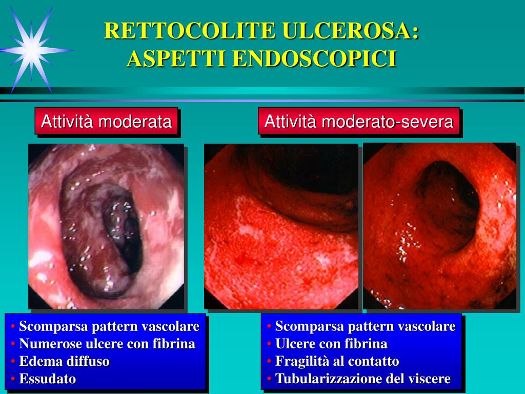 Malattia Infettiva Intestinale Cruciverba PPT - MALATTIE INFIAMMATORIE CRONICHE INTESTINALI PowerPoint