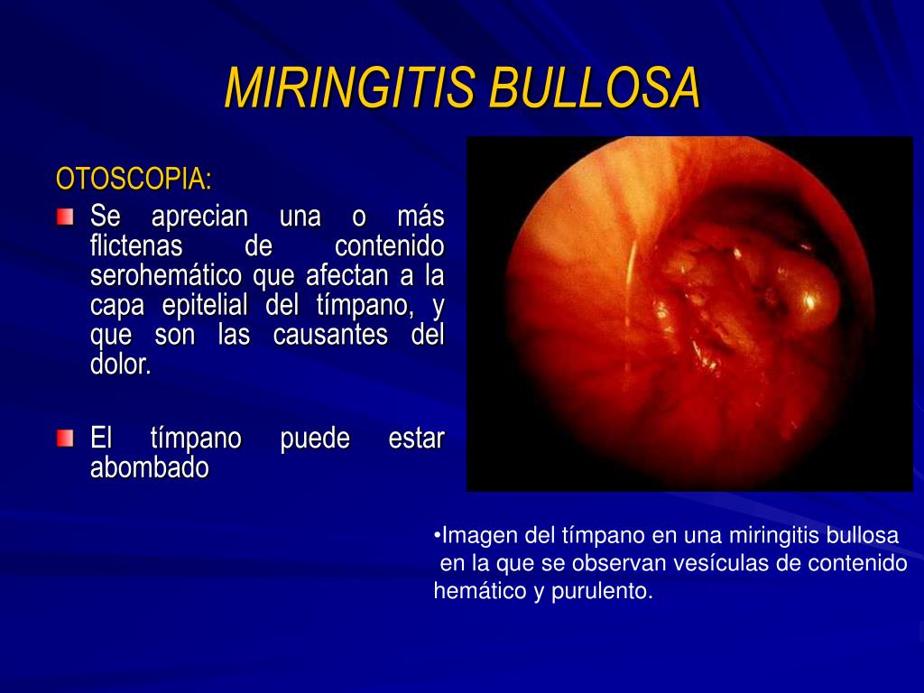 Miringitis