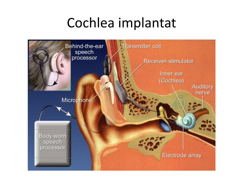 Улитка слухового аппарата. Кохлеарный имплант строение. Кохлеарная имплантация строение уха. Кохлеарный аппарат анатомия. Операция на слуховой нерв.
