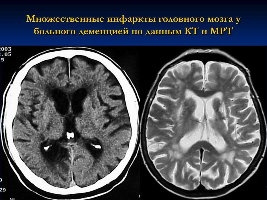 Многоочаговое поражение мозга. Дисциркуляторная энцефалопатия головного мозга на кт. Деменция на мрт головного мозга. Кт головного мозга при дисциркуляторной энцефалопатии. Сосудистая деменция мрт.