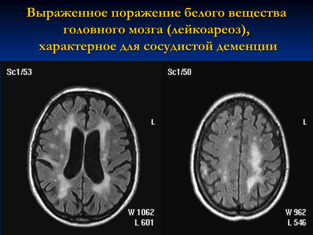 Атрофия вещества головного мозга. Лейкоареоз на кт. Перивентрикулярный лейкоареоз на кт. Перивентрикулярный лейкоареоз( 1 ст). Хроническая ишемия головного мозга мрт.