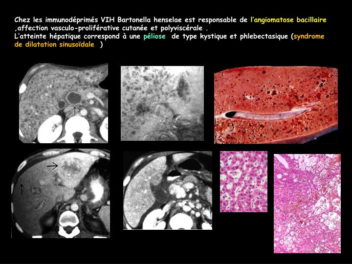PPT - Imagerie des infections hépato-biliaires PowerPoint Presentation ...