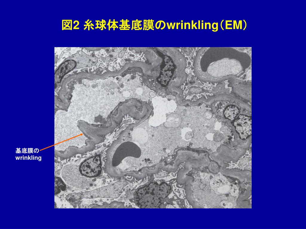 PPT - 良性腎硬化症 PowerPoint Presentation, free download - ID:931828