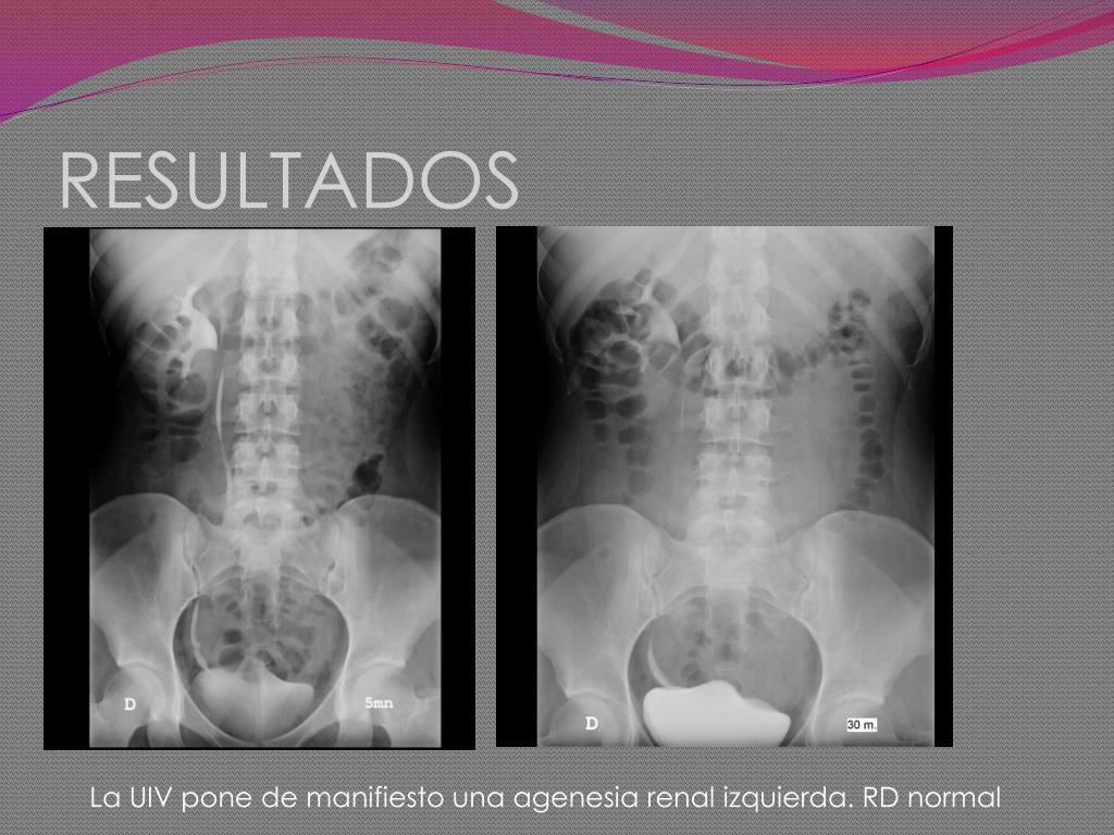 agenesia renal izquierda los