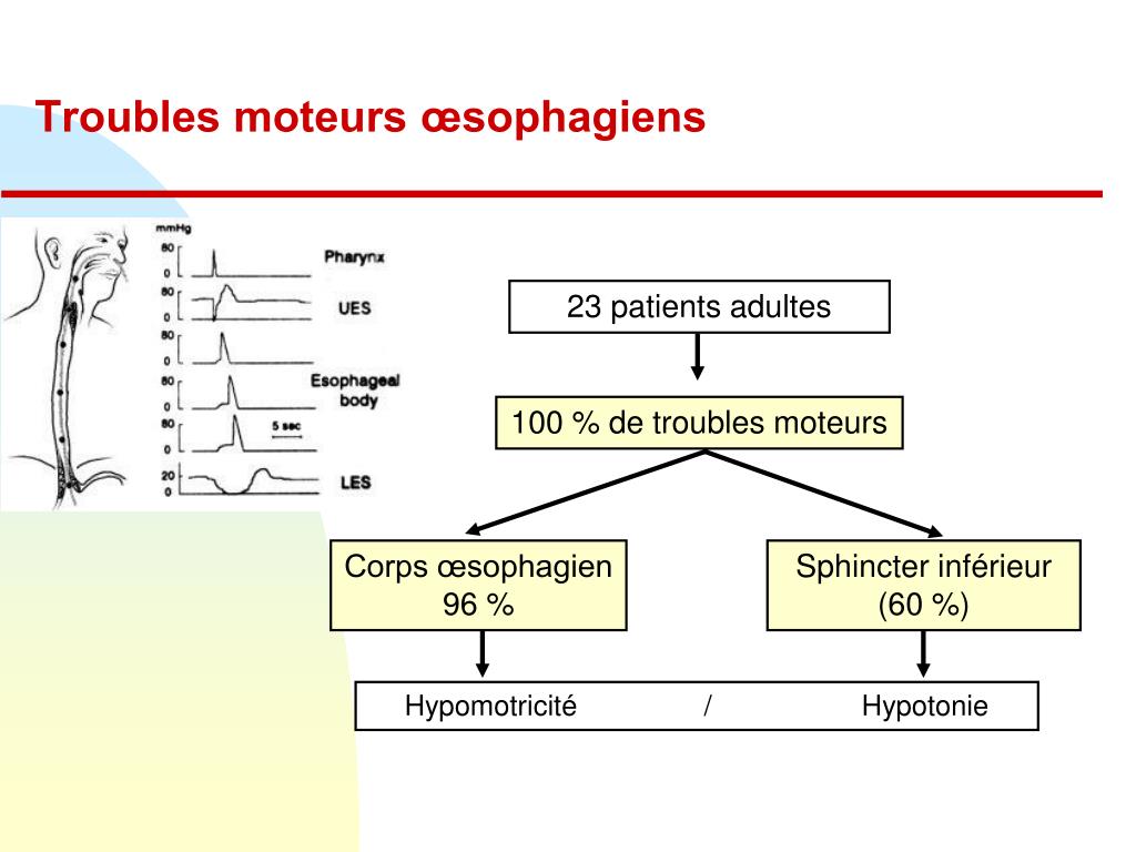 Atresie De Loesophage Esperance De Vie Atrésie De L'oesophage Esperance De Vie - Communauté MCMS