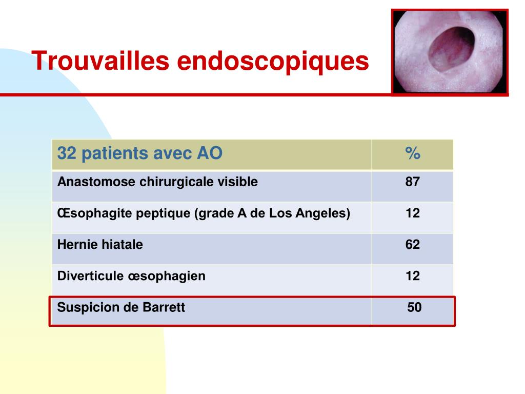 Atresie De Loesophage Esperance De Vie Atrésie De L'oesophage Esperance De Vie - Communauté MCMS