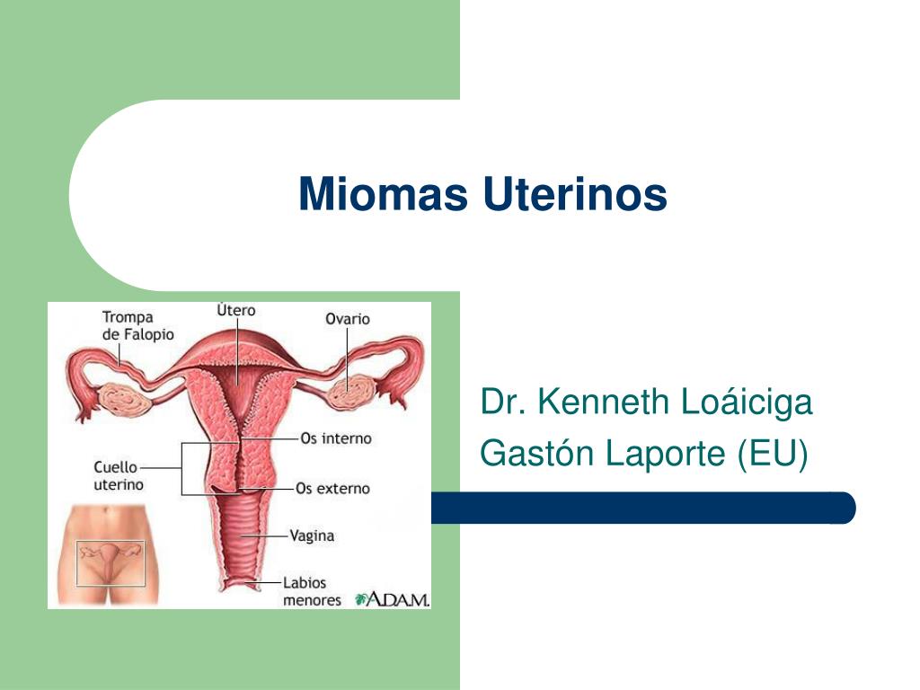 PPT - Miomas Uterinos PowerPoint Presentation, Free Download - ID:943990