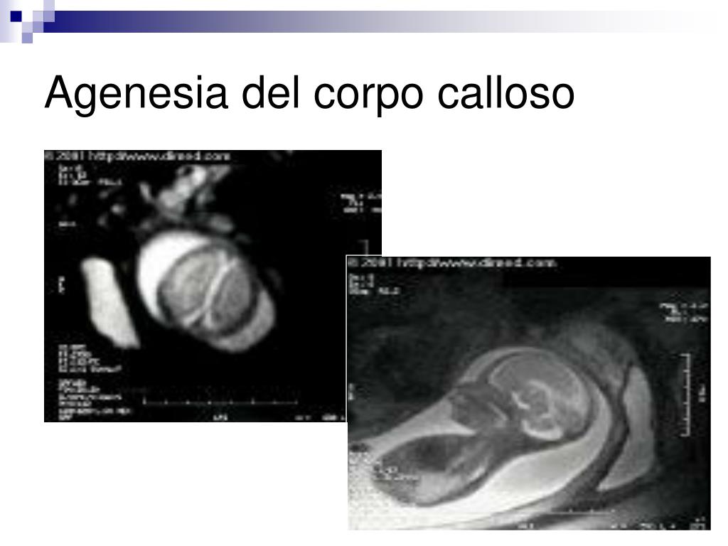 agenesia renale inoltre inquinamento