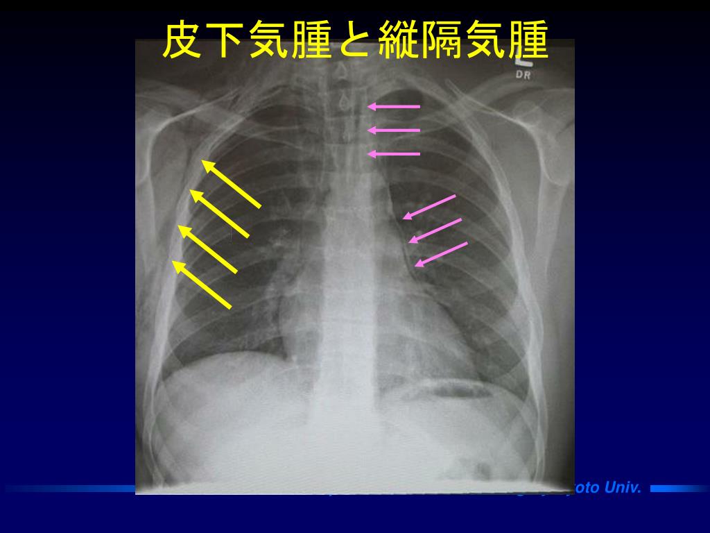 Ppt S4 胸部外傷 肺移植 Powerpoint Presentation Free Download Id 9560 Ppt S4 胸部外傷 肺移植 Powerpoint Presentation Free Download Id 9560