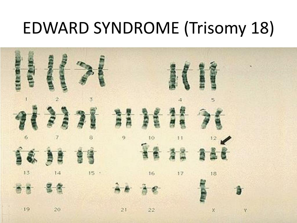 Пересадка хромосом. Трисомия по 18 хромосоме кариотип. Трисомия по 18 хромосоме синдром Эдвардса. Синдром Эдвардса кариотип. Транслокация кариотип.