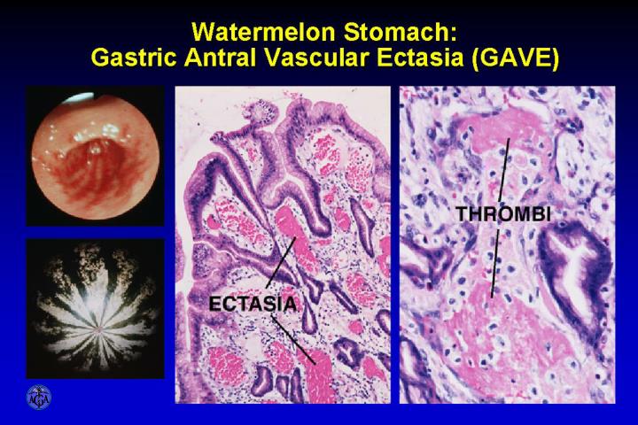 Watermelon and h pylori