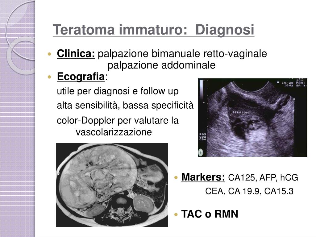 PPT TERATOMA IMMATURO DELL’OVAIO PowerPoint Presentation, free