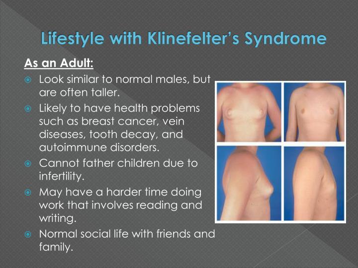 Ppt Klinefelter S Syndrome Powerpoint Presentation Id 963511
