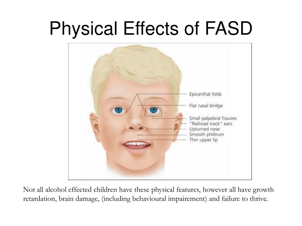 Ppt Fetal Alcohol Spectrum Disorder Fasd Powerpoint Presentation Free Download Id 974671