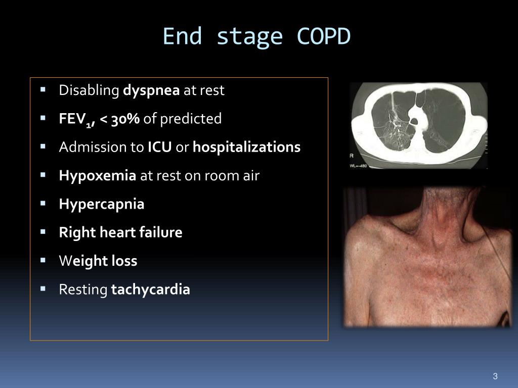 end stage copd case study
