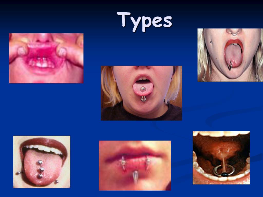 PPT - “Mouth Jewelry-It’s Not As Simple As You Think!” PowerPoint ...