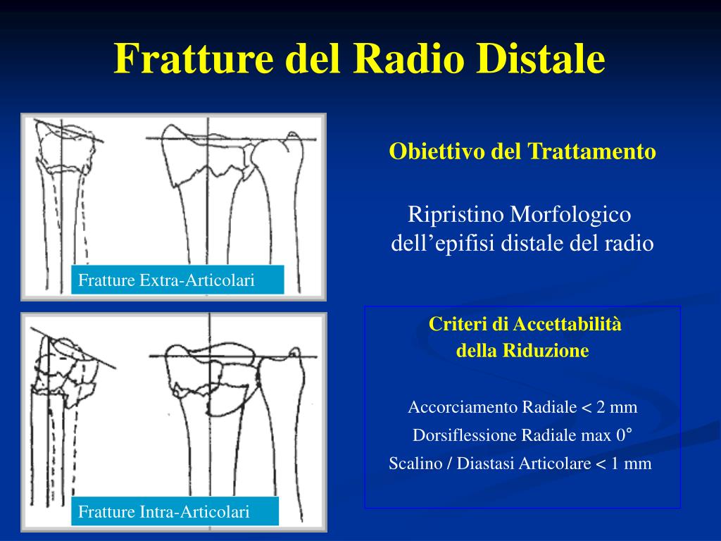 Taglierina Estremità Distale Dentale TC Taglio E Tenuta - Foto 2