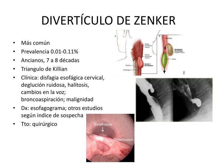 PPT PATOLOGIA BENIGNA DEL ESOFAGO PowerPoint Presentation ID 993440 ppt-patologia-benigna-del-esofago-powerpoint-presentation-id-993440